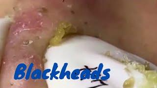 extreme blackhead removal | Squeezing big pimples #9