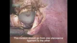 Laparoscopic Vaginal Extraction of Ovarian Tumor