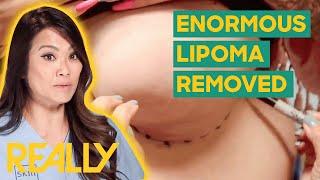 Dr. Lee Removes A Massive Lipoma Resembling A Third Breast | Dr. Pimple Popper