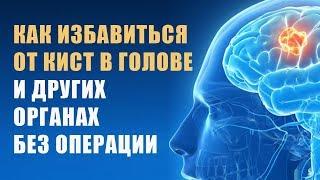 Смотрите Как Избавиться от Кисты Без Операции