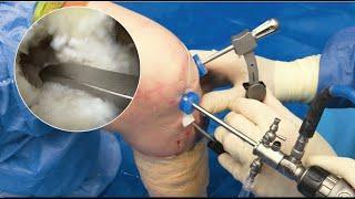 Combined ACL and Meniscal Root Tunnel Drilling