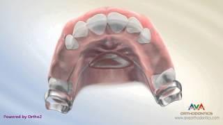 Orthodontic Space Management - Nance Appliance