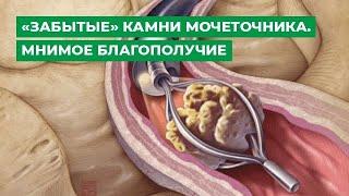 «Забытые» камни мочеточника. Мнимое благополучие.