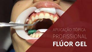 Aplicação Tópica Profissional de Flúor Gel (ATF)