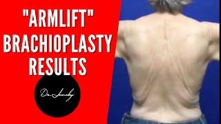 Brachioplasty ( Armlift) Results DrJeneby ! #shorts