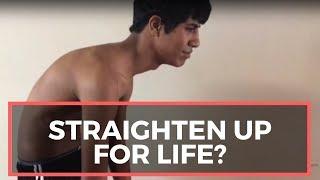 Gonstead Chiropractic Helps Teenager Acute Pain Extreme Kyphosis & Dead Leg - Chiropractor Meridian