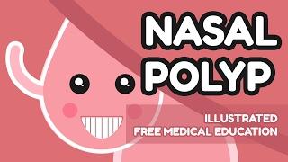 What is Nasal Polyp?