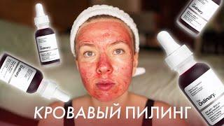 Кровавый пилинг The Ordinary AHA 30% + BHA 2% Peeling Solution | Отшелушивание | Прыщи | Проблемная