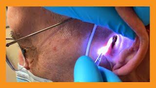 Dueling Cerumen Clearances | Auburn Medical Group