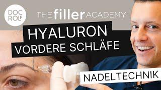 SCHLÄFENAUFBAU MIT HYALURON (Nadeltechnik) – TFA by doc.rolf