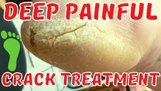Deep painful crack treatment. Thick skin removal.