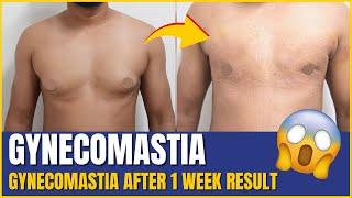 Recovery after Gynecomastia Surgery | 1 week post op result