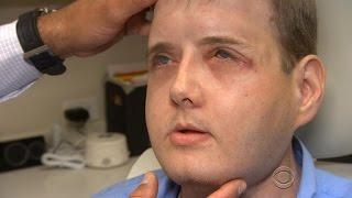 Face transplant recipient thriving one year after surgery