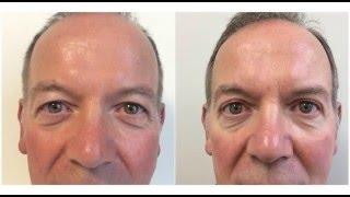 Upper Blepharoplasty (Eyelid Removal)  at The Private Clinic - Before and After