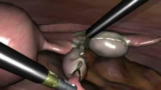 LapSim Gynecology: Salpingectomy