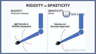 Rigidity vs Spasticity Explained