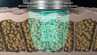 Onda Coolwaves™ at Cambridge Therapeutics for Fat Reduction, Cellulite & Skin Tightening