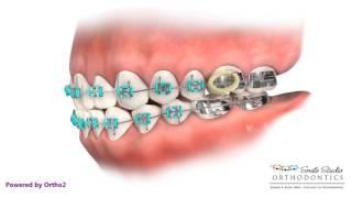 Elastics - Class III - Orthodontic Treatment