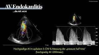 〖Echokardiografie〗 Aortenklappenendokarditis bei i.v. Drogenabusus 🫀