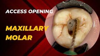 Access Opening of Maxillary Second Molar
