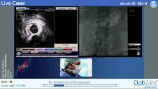 sinus-XL Stent-OptiMed