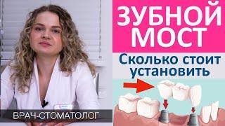 Зубной мост - сколько стоит установить зубной мост, виды зубных мостов. Цена зубного моста.