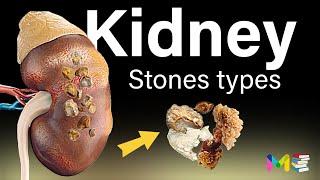 TYPES OF KIDNEY STONES