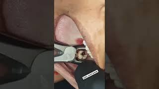 3RD MOLAR EXTRACTION #SHOTS