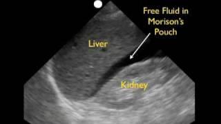 FAST RUQ Exam - Hemorrhage - SonoSite, Inc.
