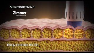 Skin Tightening and Body Contouring - Z Wave by Zimmer (Medical Device 3D Animation)