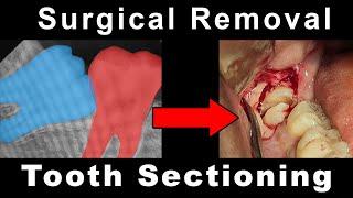 Surgical Removal of Impacted Third Molar