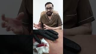 Seroma Kya Hota hai in Gynecomastia | Gynecomastia Surgery #short #Short #shorts #share