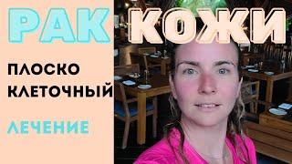 Рак кожи.Плоскоклеточный рак - ПРК. НЕ ПУТАТЬ с бородавкой. Самодиагностика. Виды Лечения и прогноз.