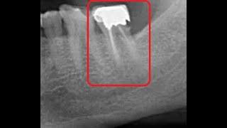 Reinfected root canal treated molar tooth removal in chennai