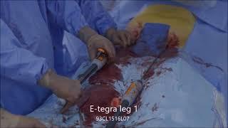 Endovascular treatment of aorto-iliac aneurysm with E-tegra & E-liac by Dr. Bouwman & Dr. Sikkink