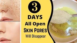 3 Days and All Open Pores Will Disappear from Your Skin Forever