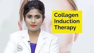 Collagen Induction Therapy | Skin Diaries