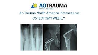 Osteotomy Week 9: June 13: M Bernstein, The Ilizarov method for tibial Malunion/Nonunion