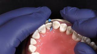 NEW Fusion Anterior Matrix System from Garrison Dental Solutions