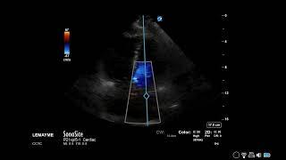 How to...Measure MVA using PHT or Deceleration Time