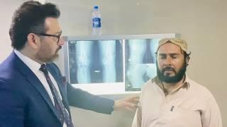 Proximal tibial osteotomy : Dr Umer Butt