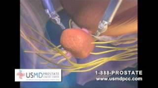 Prostate surgery with the daVinci Robot