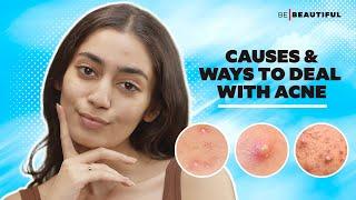 What Does Your Acne Mean & How to Treat Acne | Hacks For Clear Skin | Skincare Tips | Be Beautiful