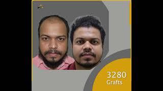 Hair Transplant Results by Dr Alok Sahoo M.D (AIIMS, New Delhi) | Book an appointment today