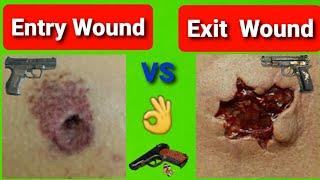 Difference between Entry wound and Exit wound