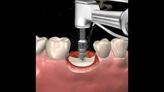 Step by step dental implant surgery.  Gary R. O'Brien, D.D.S.