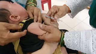 Injectable Polio Vaccine (IPV), Intradermal injection technique