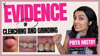 Physical Evidence of Clenching & Grinding/Bruxing - Priya Mistry, DDS (the TMJ doc) #clenchingteeth