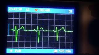 #55 心音と心電図と期外収縮 Female Heartbeat, ECG, and Skip