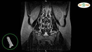 Что покажет МРТ пояснично-крестцового отдела позвоночника (снимки) видео